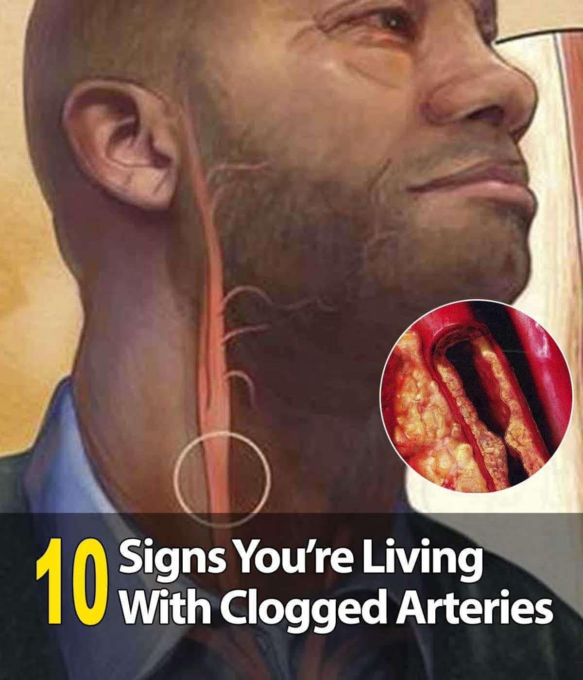 10 Warning Signs of Blocked Arteries