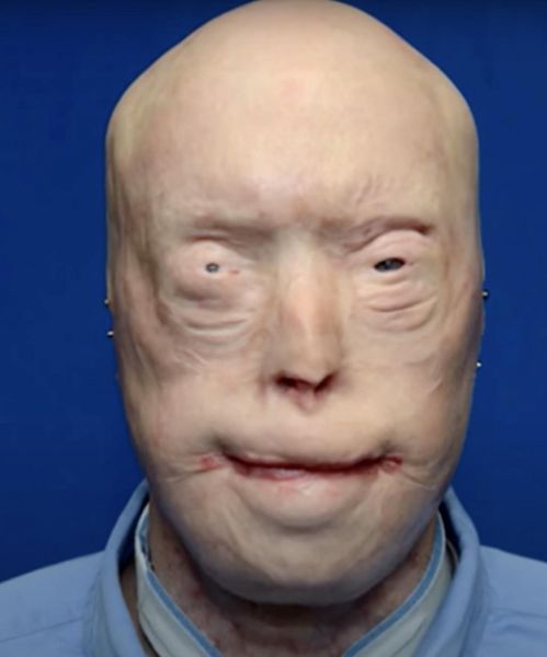 Firefighter suffers third-degree burns – this is him 7 years later