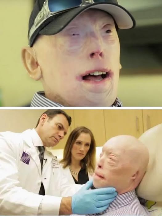 Patrick Hardison received a new face after third-degree burns, this is him today…