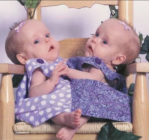 Cojoined twin sisters who were famously ‘cut In half’ in 2006 are now living as separate teenagers